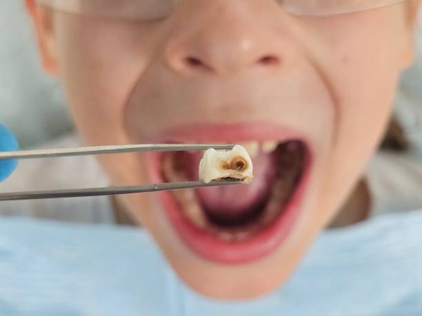 Best Pediatric Emergency Dentist in Mount Pleasant, TN
