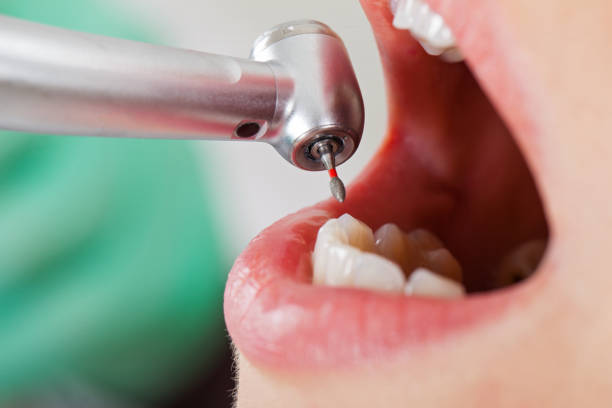 Best Emergency Dental Extractions in Mount Pleasant, TN